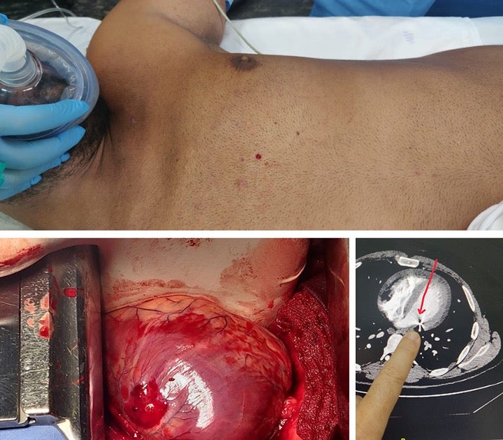 A metal pellet struck lawyer Firas Hamdan and punctured his heart, as shown in the x-ray. 