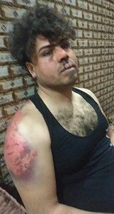 علي نصير علوي، بعد أن ضربه مسلحون ملثمون واستخدموا خليطا حمضيا في محاولة لإزالة الوشم على ذراعه.