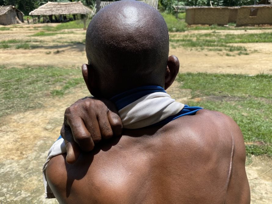 An Indigenous Iyeke man shows a scar from a machete wound in Sambwakoy, Tshuapa province, Democratic Republic of Congo, October 2021. 