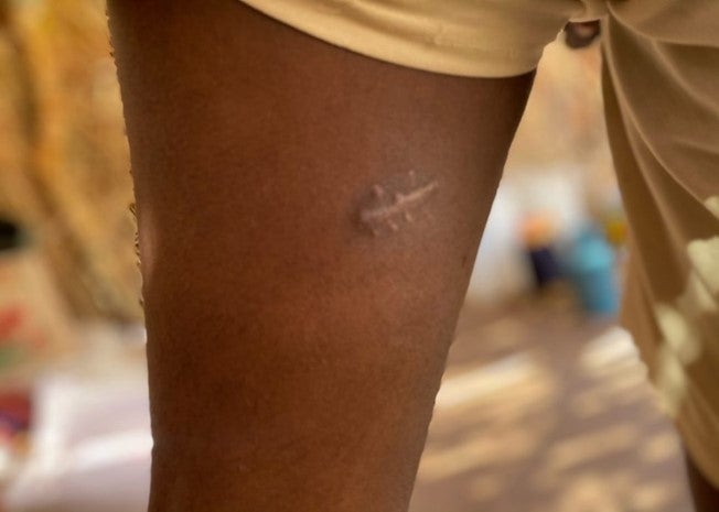 Close up of a scar