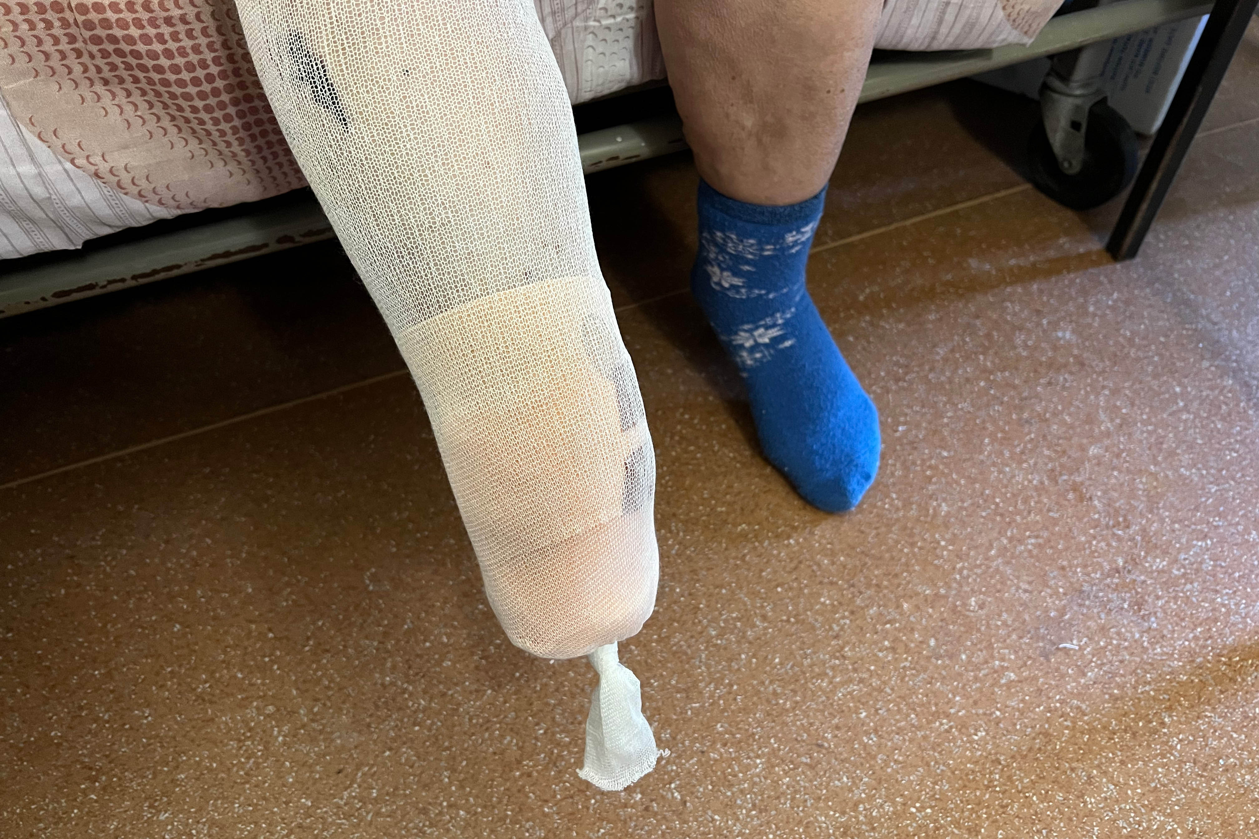 Residente que perdió el extremo inferior de la pierna tras posarse sobre una mina antipersonal PFM cerca de su vivienda.  