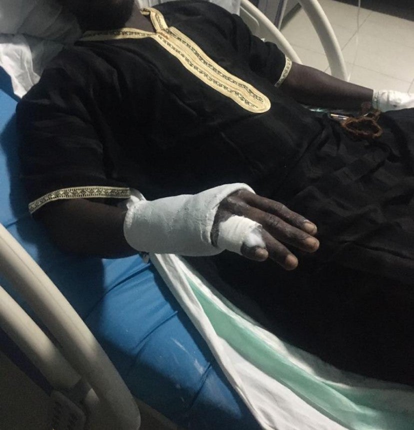 A 28-year-old man and PASTEF member, arrested by gendarmes in Mbour, Thiès region, at a pro-opposition protest, on June 1, 2003, shows the serious injuries, including a broken finger, that he sustained after being tortured for several hours.