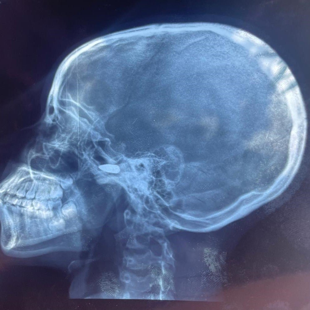 Das Röntgenbild eines 15-jährigen Mädchens, das am 9. Mai 2024 in Bébédja im Süden des Tschad von einem Querschläger in den Kopf getroffen wurde, nachdem die vorläufigen Ergebnisse der Präsidentschaftswahlen im Tschad bekannt gegeben worden waren.
