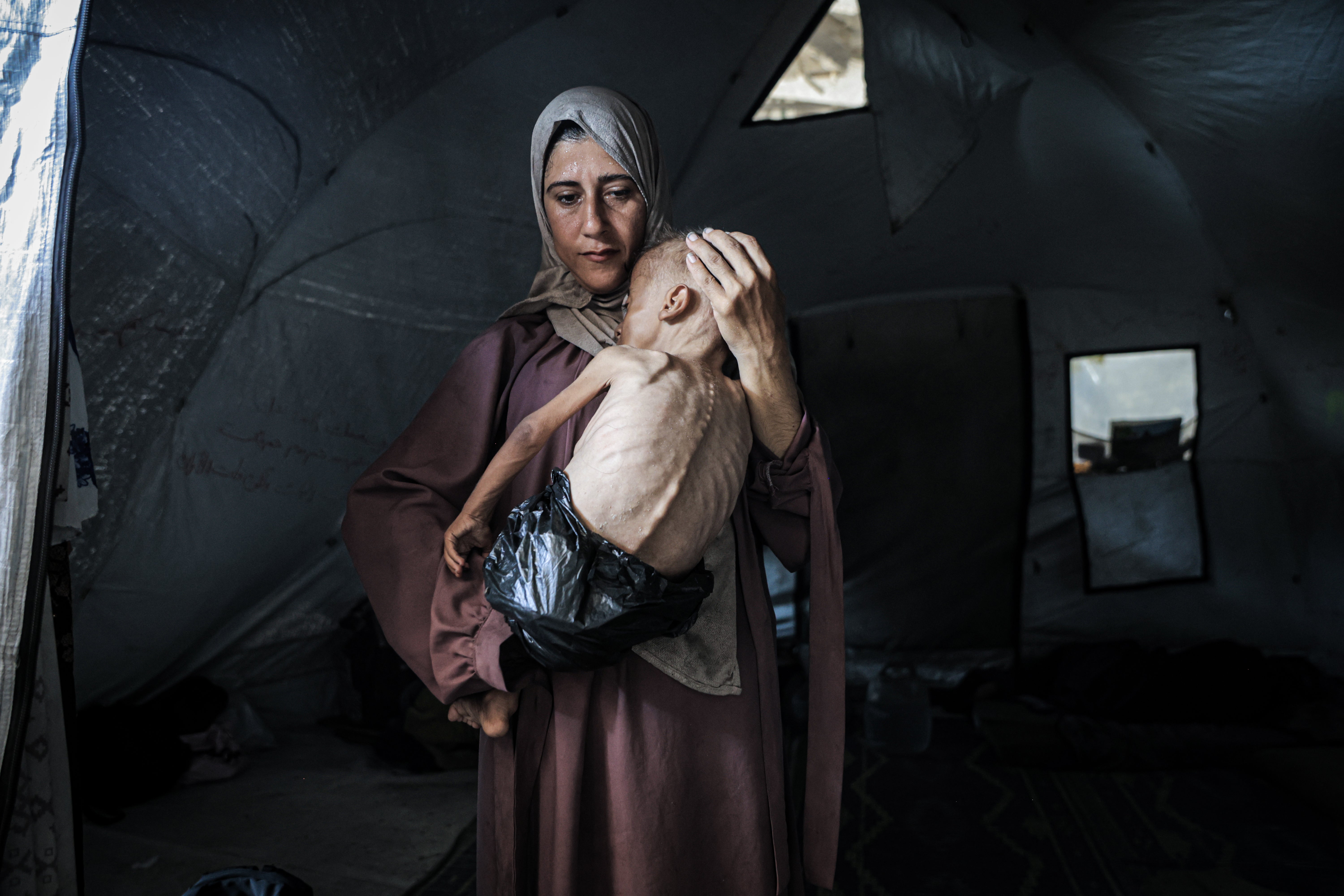 Eighteen-month-old Muhammad Zakariya Ayyoub al-Matouq faces life-threatening malnutrition as the humanitarian situation worsens due to ongoing Israeli attacks and the blockade in Gaza City, Gaza, July 21, 2025. 