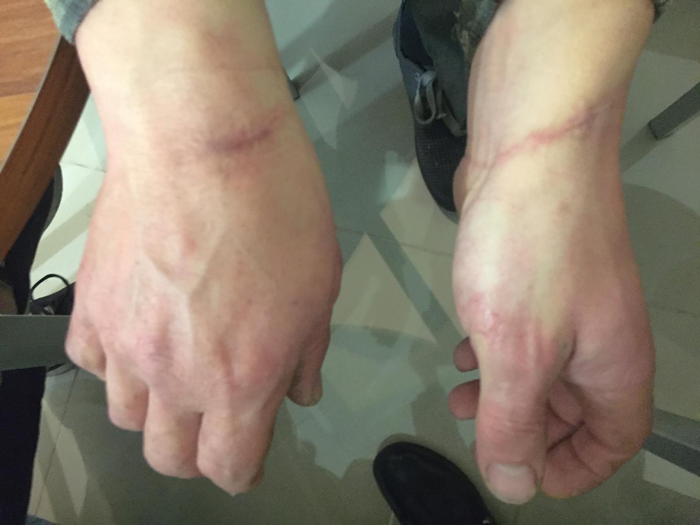 Сліди від кайданок на зап'ястях людини, яку проросійські сепаратисти на сході України утримували в одиночній камері та піддавали тортурам. (Листопад 2016 року, м. Маріуполь). 