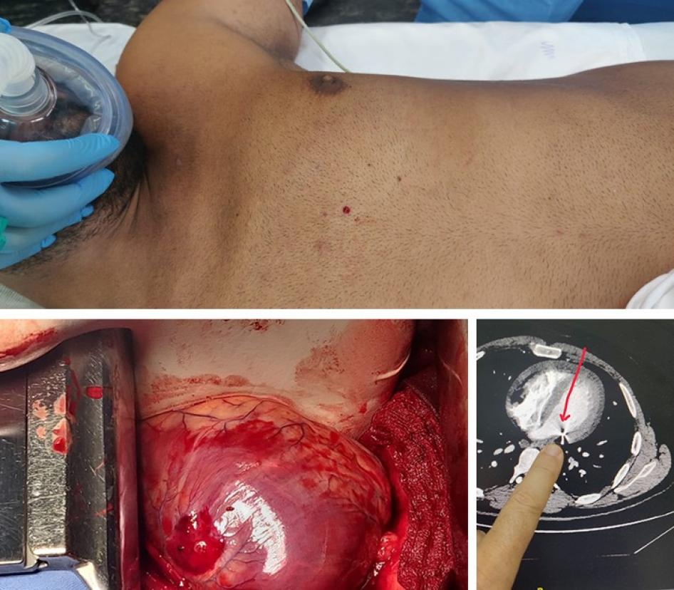 A metal pellet struck lawyer Firas Hamdan and punctured his heart, as shown in the x-ray. 