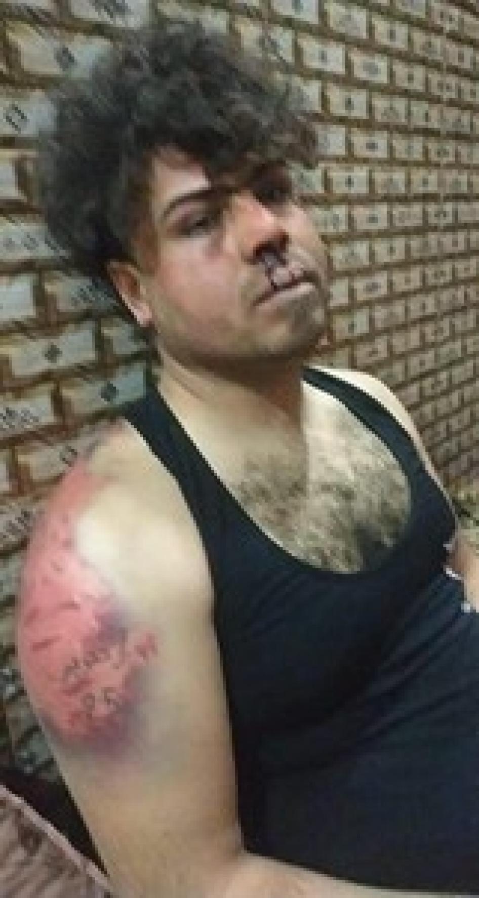 علي نصير علوي، بعد أن ضربه مسلحون ملثمون واستخدموا خليطا حمضيا في محاولة لإزالة الوشم على ذراعه.