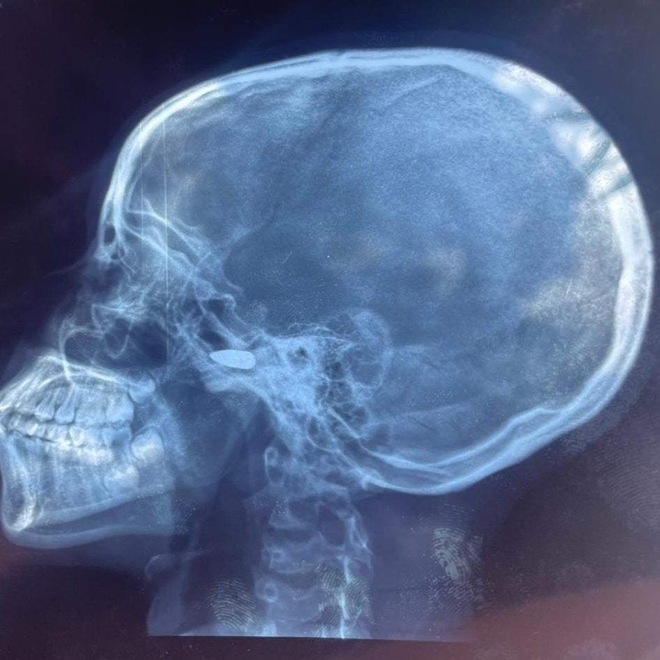 Radiographie d'une fille de 15 ans qui a été touchée à la tête par une balle perdue à Bébédja, au sud du Tchad, le 9 mai 2024, après l'annonce des résultats provisoires de l'election présidentielle au Tchad.