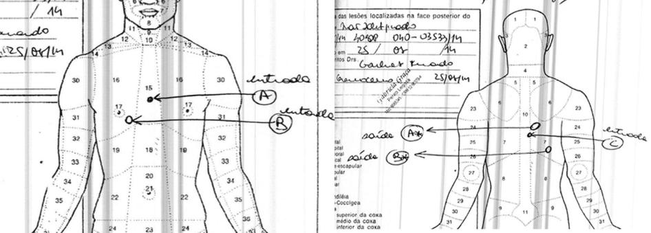 Os diagramas da autópsia do caso de Carlos Diego Santos da Silva mostram um ferimento (marcado como ‘C’) causado por uma bala que entrou pelas costas e permaneceu em seu corpo e dois orifícios de entrada próximos um do outro de tiros recebidos no peito (‘