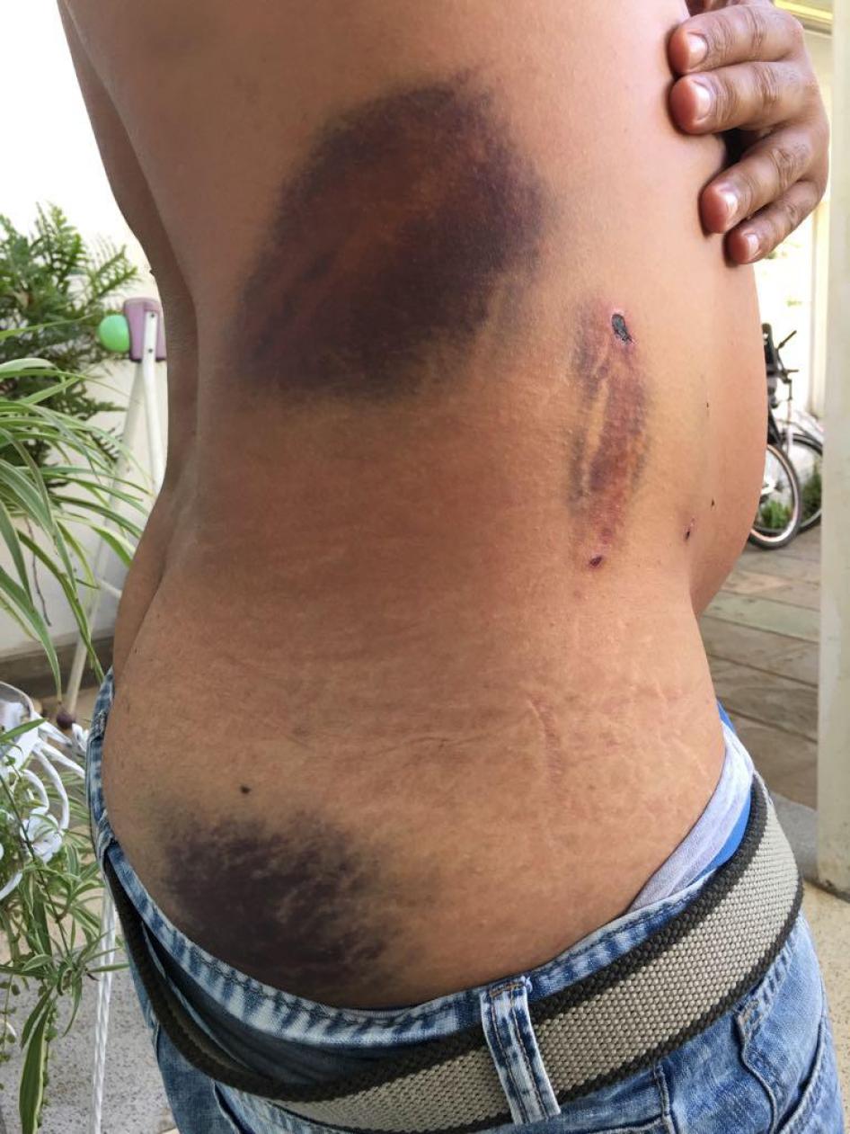 O activista Luaty Beirão mostra nódoas negras provocadas por golpes de bastões. Luanda, 24 de Fevereiro de 2017.