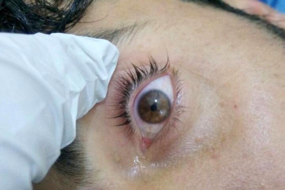  حدقة عين متقلصة بشدة ("رأس الدبوس") لرجل أصيب خلال هجوم اللطامنة في 30 مارس/آذار وفقا للجمعية الطبية السورية الأمريكية. 