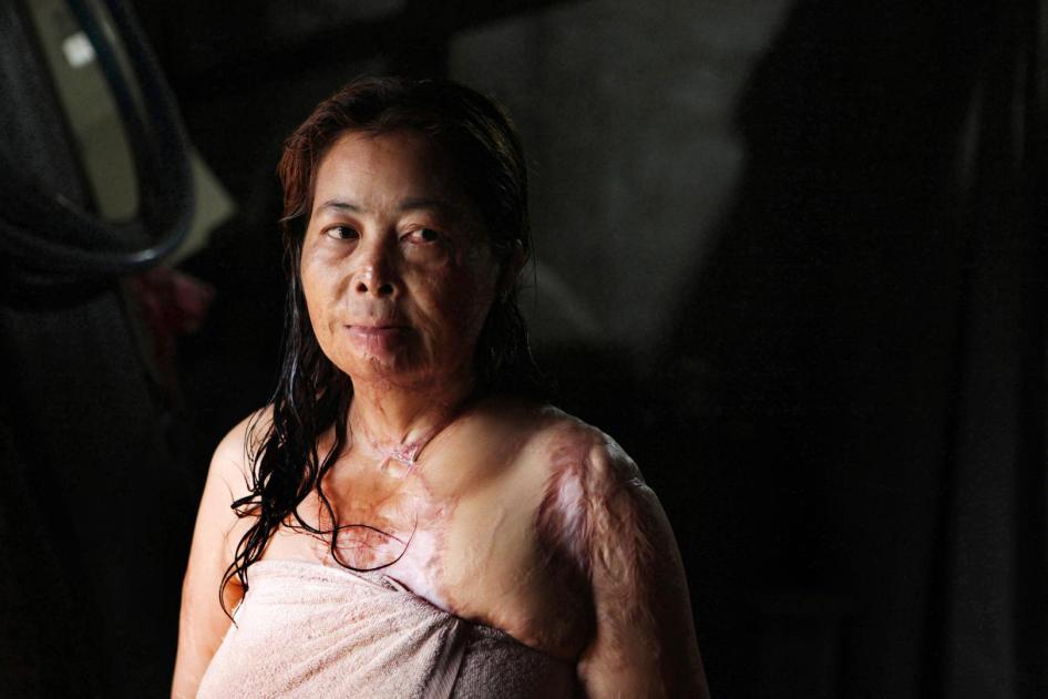 Chantheoun, the victim of an acid attack in Phnom Penh, Cambodia in September 1997. 