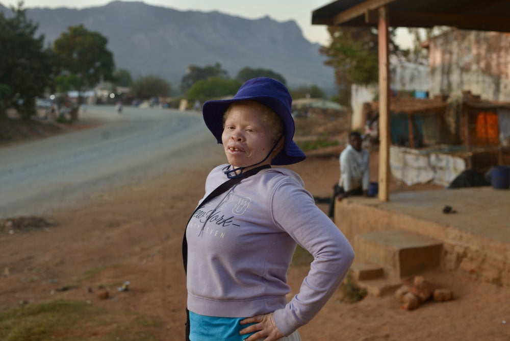 Mumderanji S., 25, from Dedza said that women with albinism faced a lot of discrimination, “We don’t get access to subsidy programs, fertilizers, coupons — we are never considered.”
