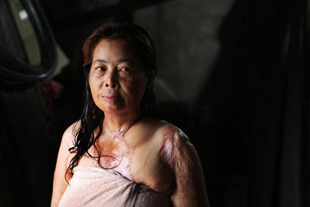 Chantheoun, the victim of an acid attack in Phnom Penh, Cambodia in September 1997. 